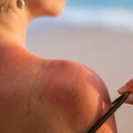 allergie au soleil