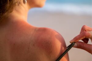 allergie au soleil