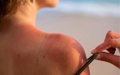 allergie au soleil